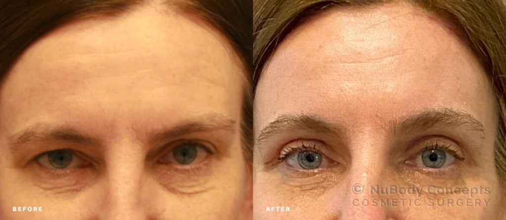 My Eyelid Surgery With Brow Lift From Start To Finish The Recovery