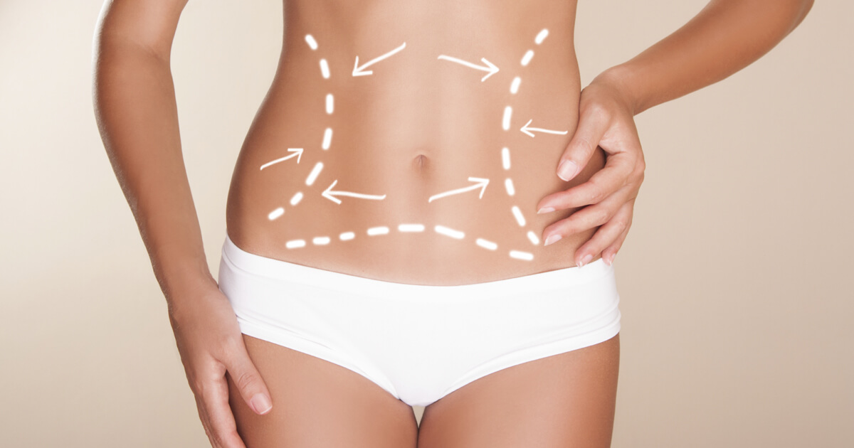 The Effectiveness of Muffin Top Liposuction - Explore Plastic Surgery