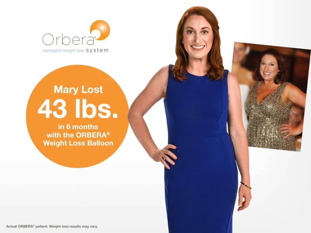 Orbera patient before and after her gastric balloon weight loss treatment