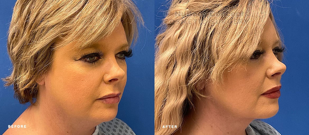 NuBody Concepts Nashville patient before and after non-surgical facelift with Renuvion - oblique view
