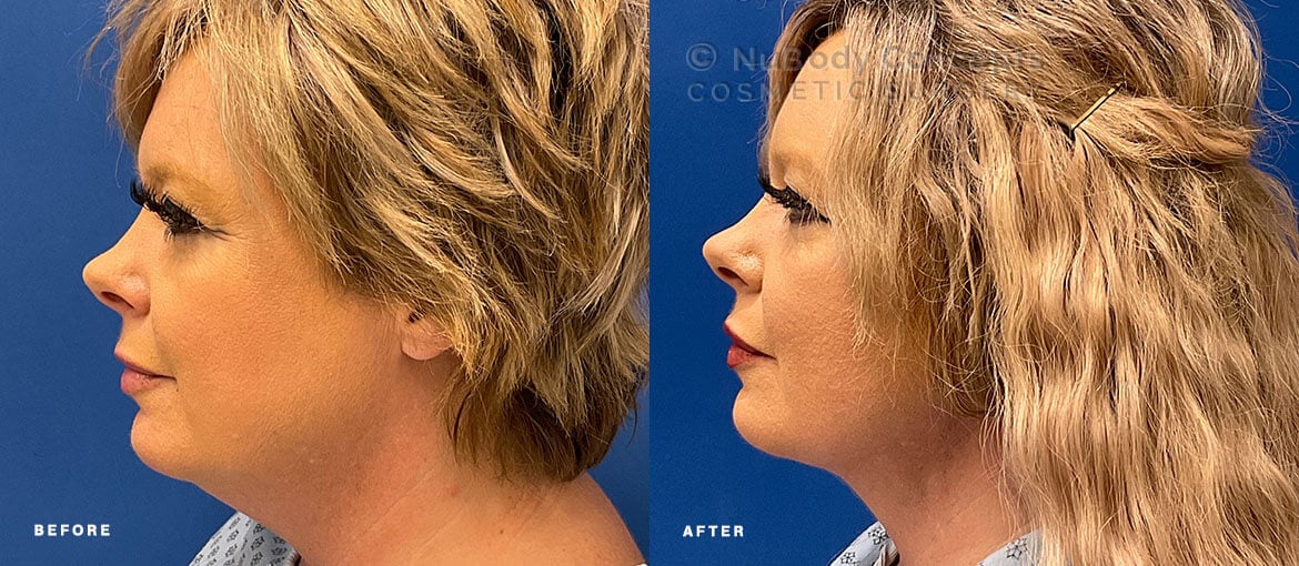 NuBody Concepts Nashville patient before and after non-surgical facelift with Renuvion - side view