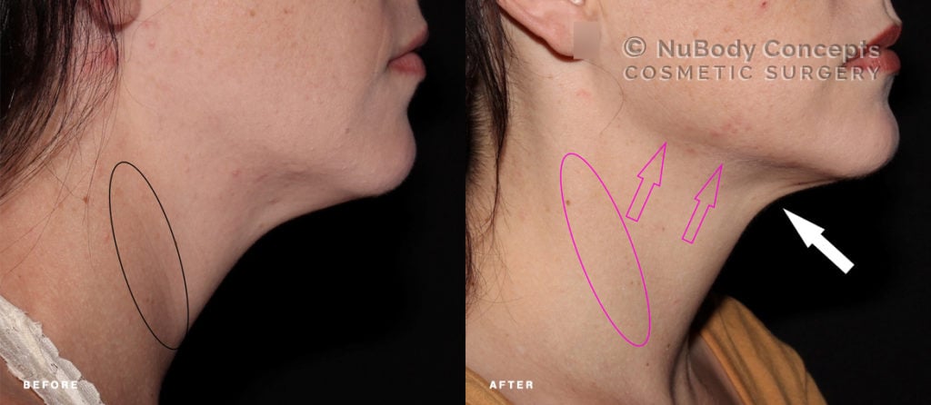 FaceTite before and after picture of NuBody Concepts patient