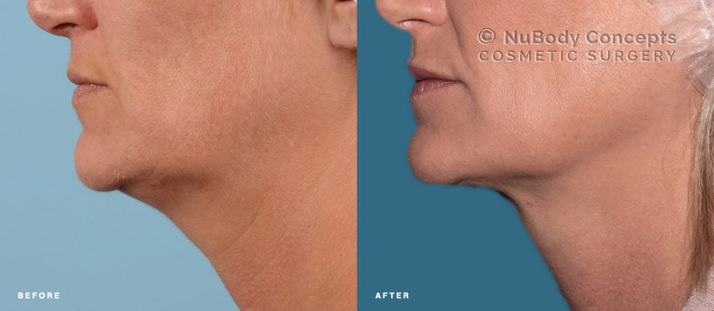 FaceTite before and after picture of NuBody Concepts patient