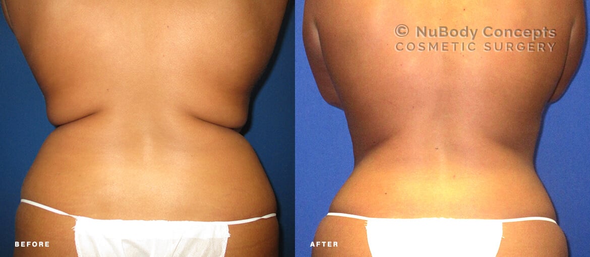 Liposuction before and after of NuBody Concepts patient