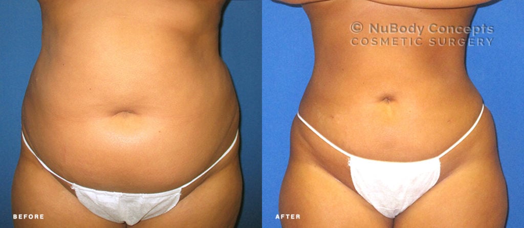 NuBodyコンセプト患者の前と後の脂肪吸引