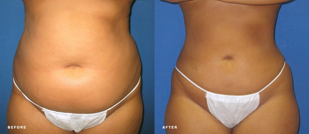 Aqualipo Liposuction before and after of NuBody Concepts patient