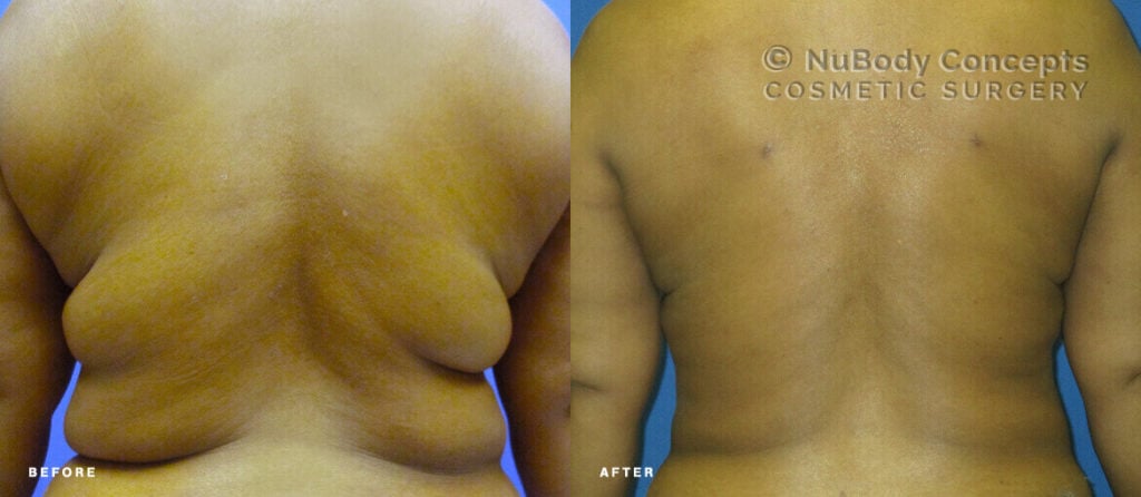 Liposuction before and after picture of NuBody Concepts patient