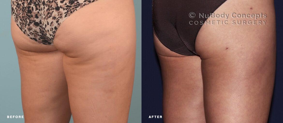 BodyTite before and after picture of NuBody Concepts patient