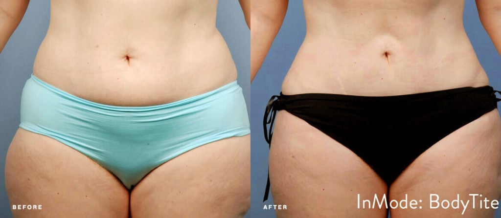 patient results of abdomen after liposuction with BodyTite skin tightening