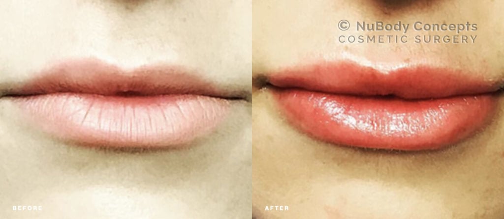 Dermal fillers before and after picture of NuBody Concepts patient