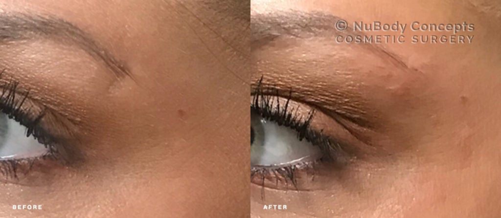 Dermal fillers before and after picture of NuBody Concepts patient