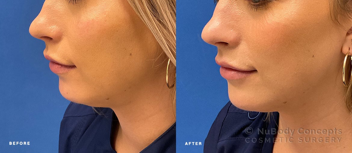 NuBody Concepts patient with versa injectable filler in chin and cheeks