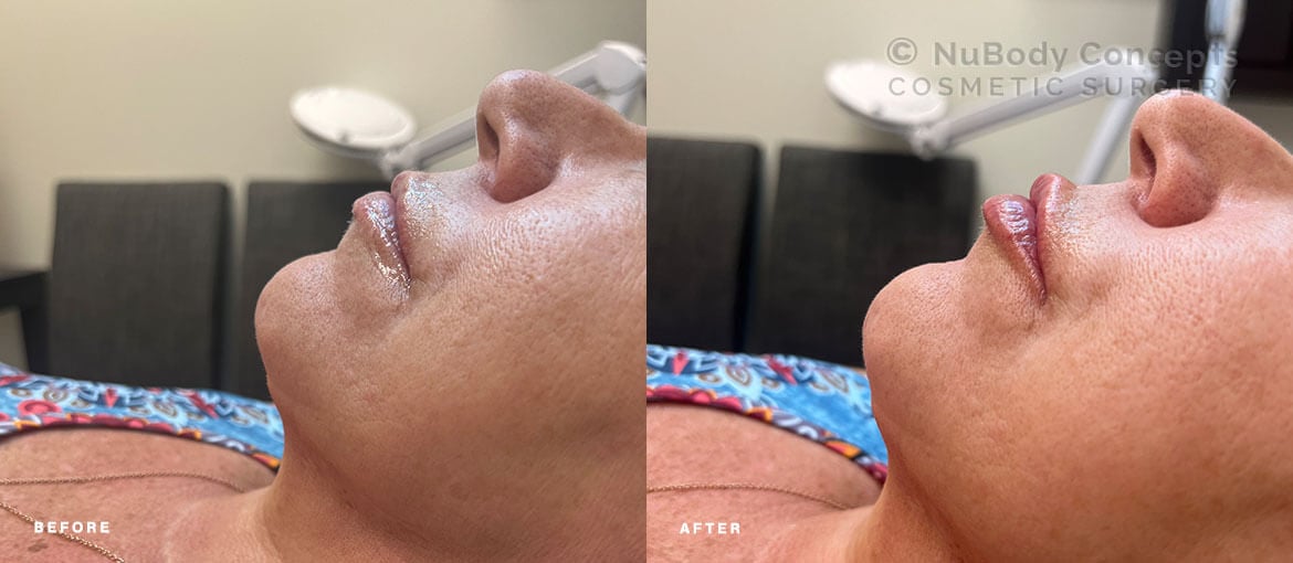 NuBody Concepts patient with injectable dermal filler in lips