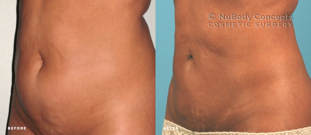 Liposuction before and after picture of NuBody Concepts patient