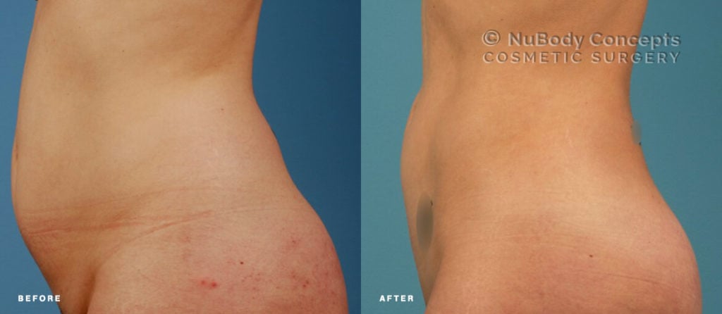 Liposuction before and after picture of NuBody Concepts patient