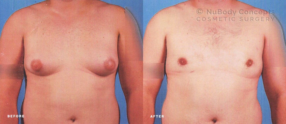 male breast reduction before and after surgery by dr mark Peters