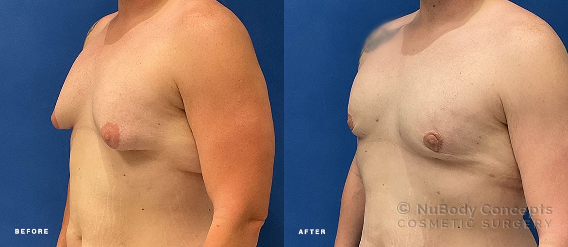 NuBody Concepts Nashville male breast reduction patient with Renuvion skin tightening before and 6 months after procedure