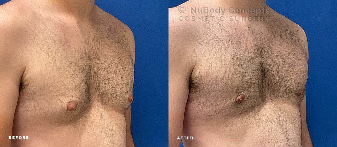 NuBody Concepts Nashville male breast reduction patient with Renuvion skin tightening before and 4 months after procedure - oblique view