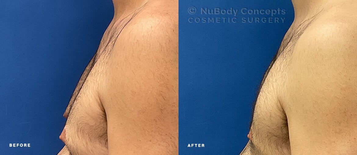 NuBody Concepts Nashville male breast reduction patient with Renuvion skin tightening before and 4 months after procedure - side view