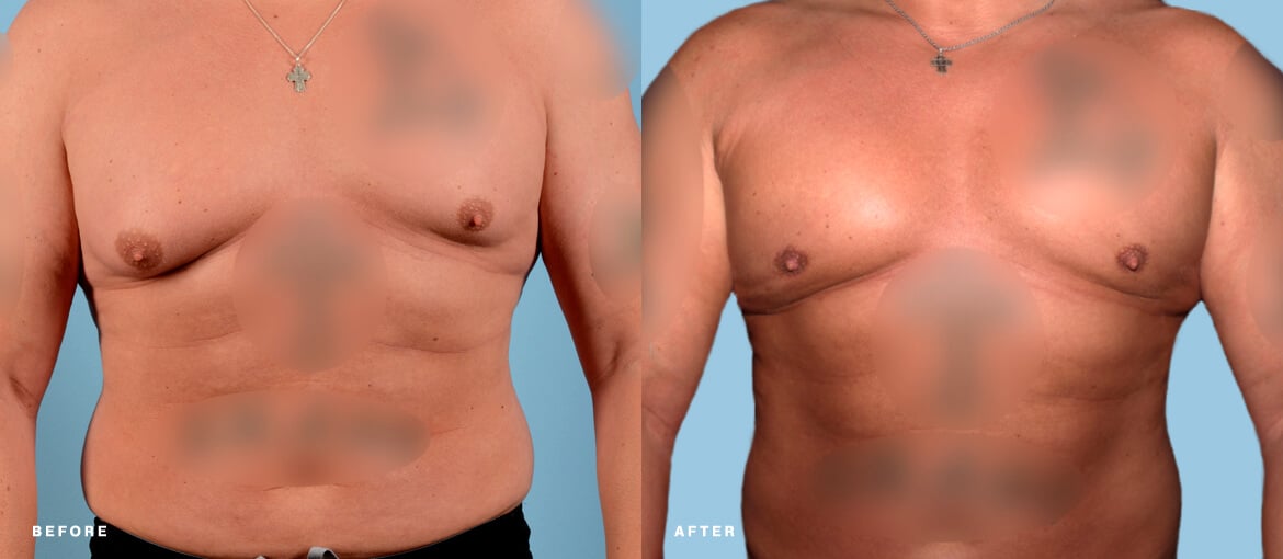 Male breast reduction before and after picture of NuBody Concepts patient