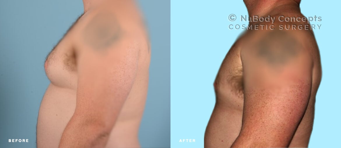 Male breast reduction before and after picture of NuBody Concepts patient