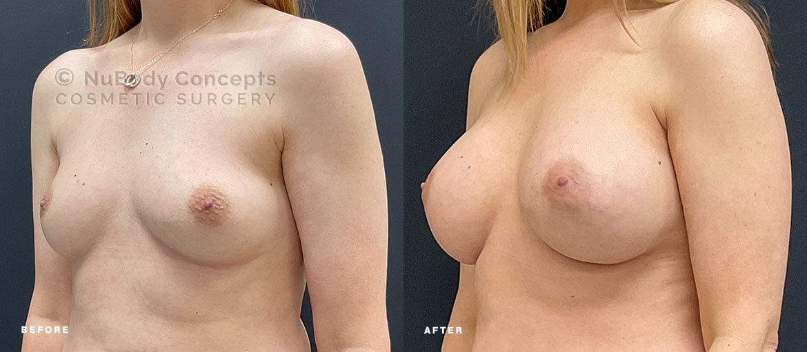 Breast implants before and after picture of NuBody Concepts patient