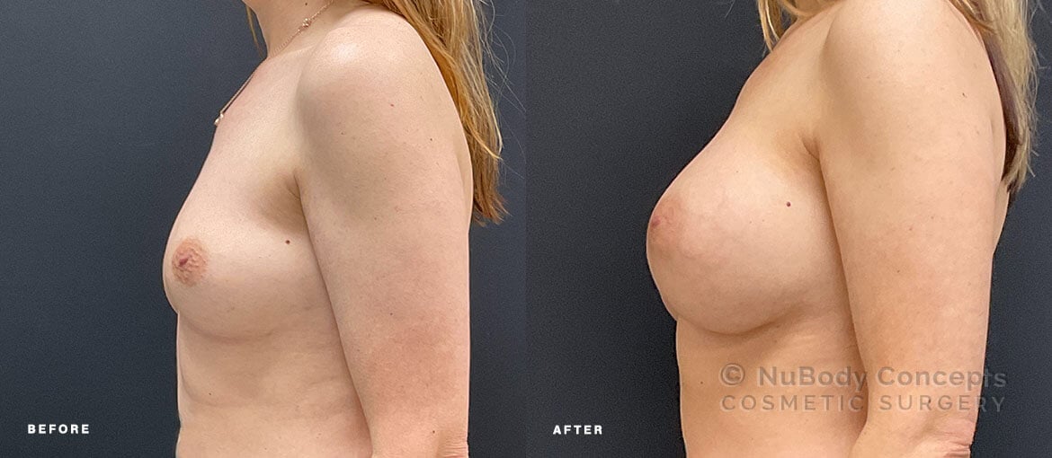 Breast implants before and after picture of NuBody Concepts patient