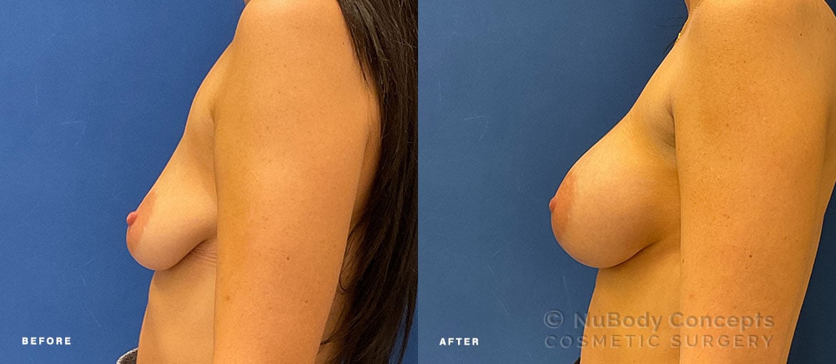 NuBody Concepts Nashville breast augmentation patient before and 6 weeks after procedure