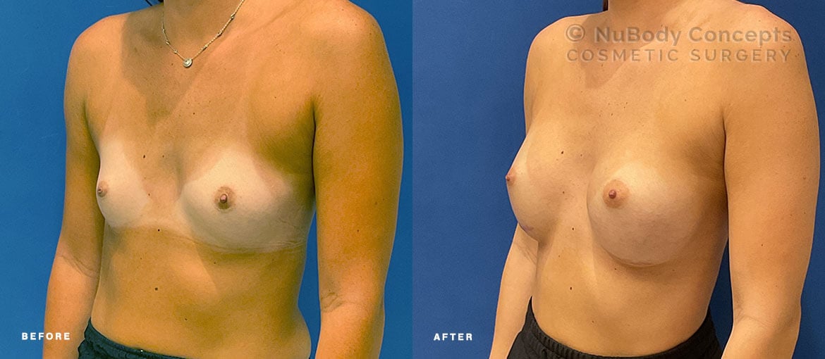 NuBody Concepts Nashville patient before and 6 months after breast augmentation surgery performed by Dr John Rosdeutscher - oblique view