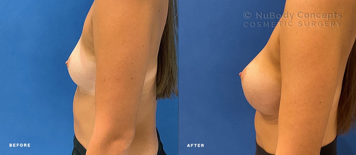 NuBody Concepts Nashville patient before and 6 months after breast augmentation surgery performed by Dr John Rosdeutscher - side view