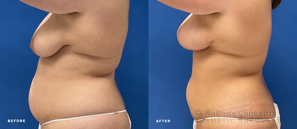 Breast lift before and after picture of NuBody Concepts Nashville patient (side view)