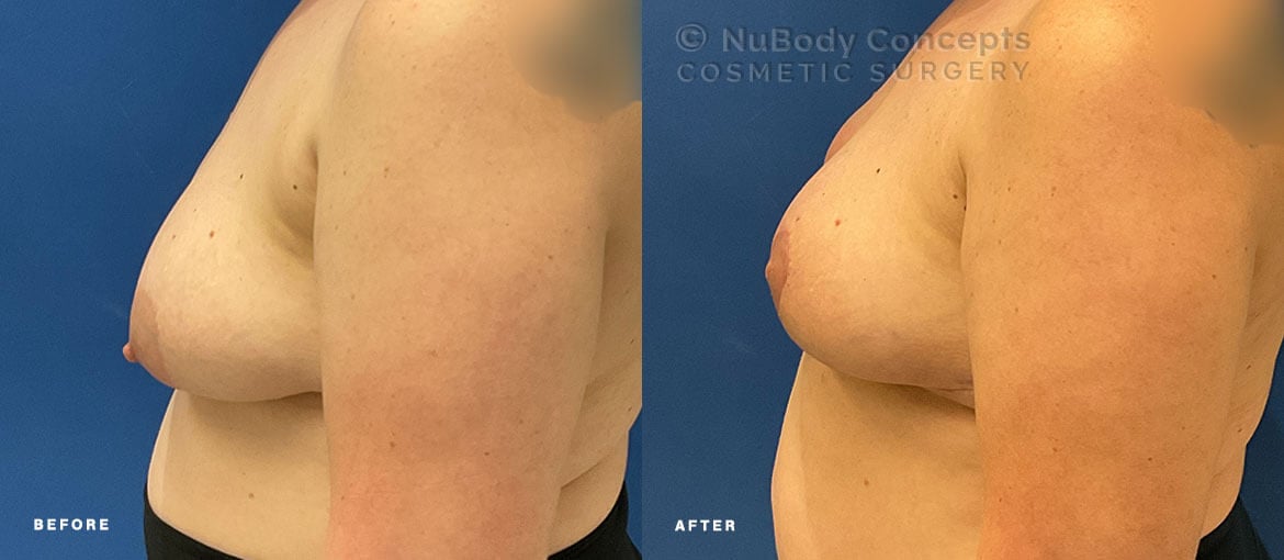 Breast lift before and after picture of NuBody Concepts Nashville patient (side view)