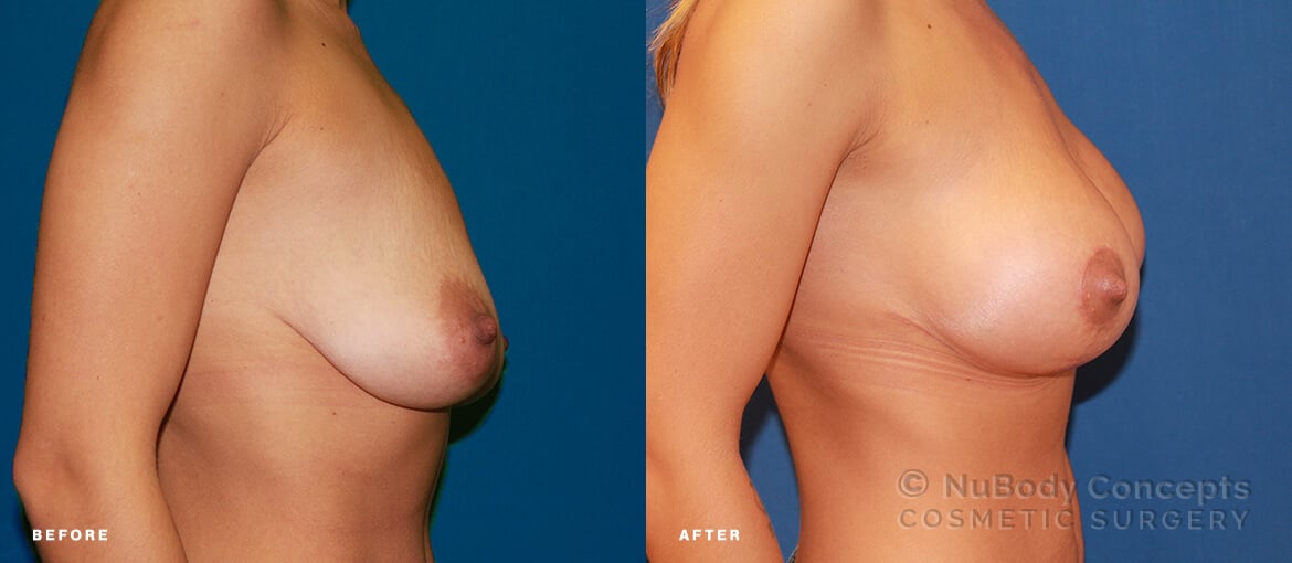 Breast lift before and after picture of NuBody Concepts Nashville patient by Dr Rosdeutscher - side