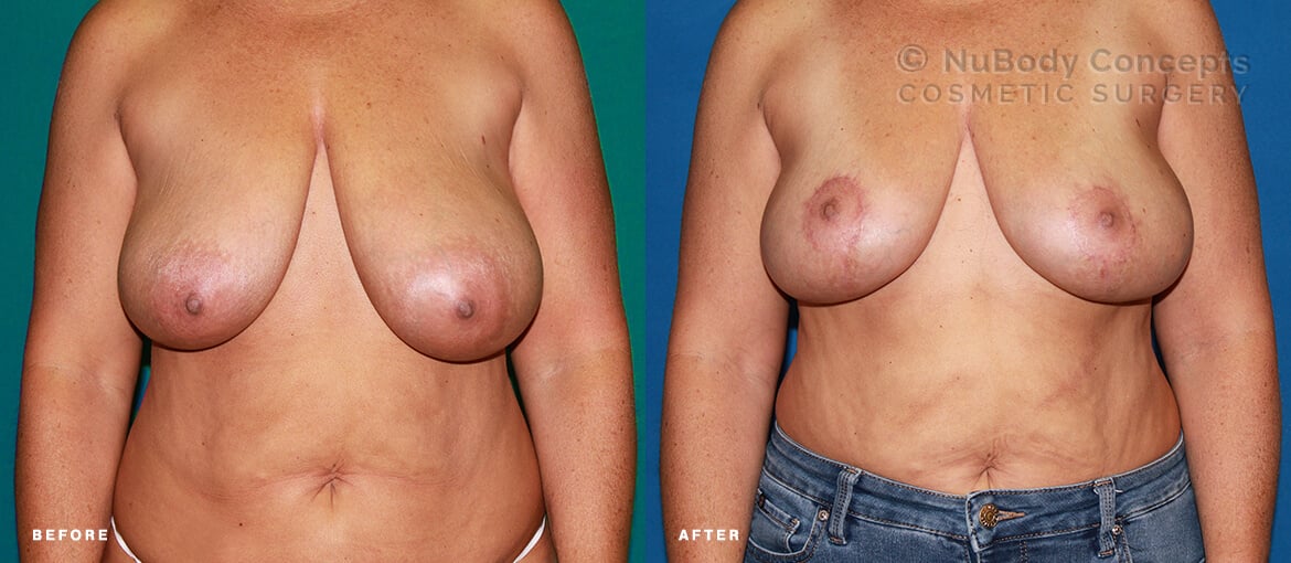 Breast lift before and after picture of NuBody Concepts Nashville patient by Dr Rosdeutscher - front