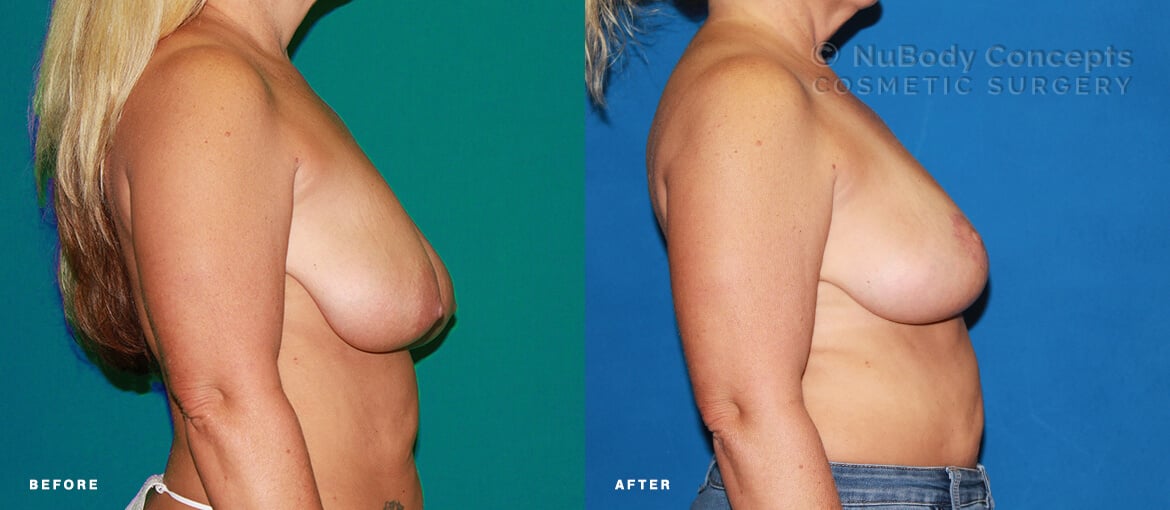 Breast lift before and after picture of NuBody Concepts Nashville patient by Dr Rosdeutscher - side