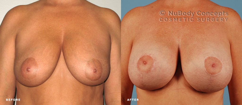 Breast lift w/ saline implants before and after picture of NuBody Concepts patient