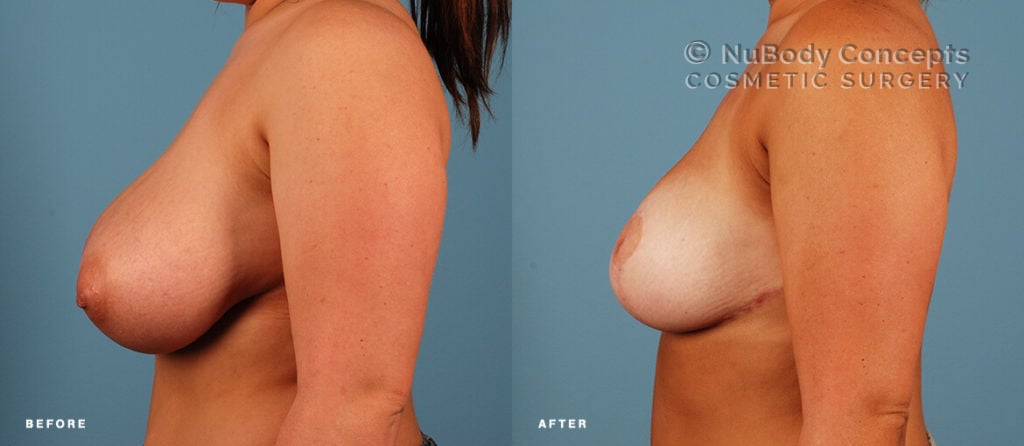 Breast reduction before and after picture of NuBody Concepts patient
