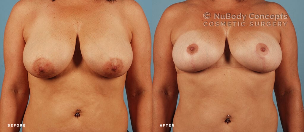 Breast reduction before and after picture of NuBody Concepts patient
