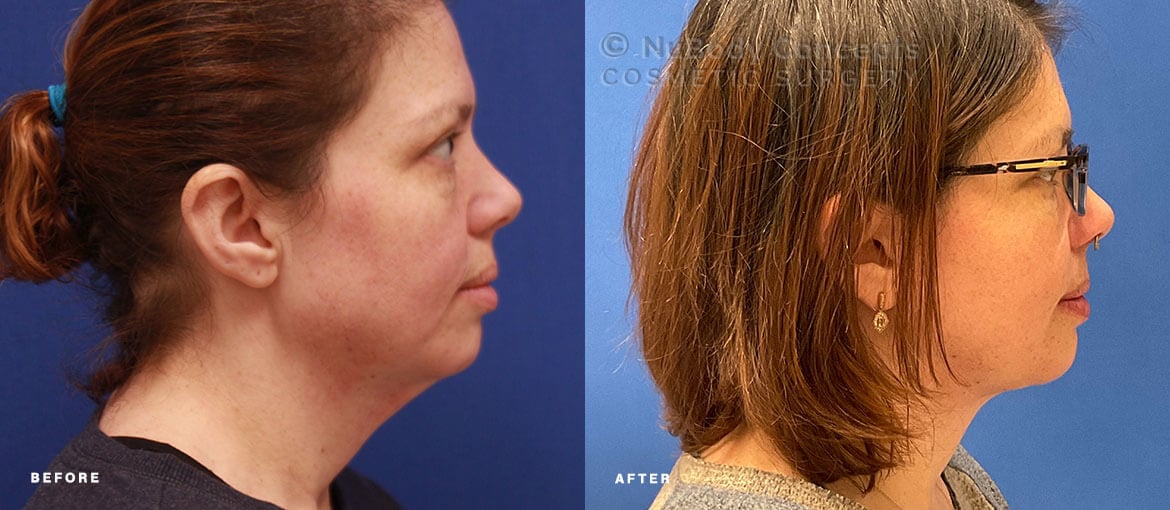 NuBody Concepts Nashville facelift patient before and 12 months after procedure