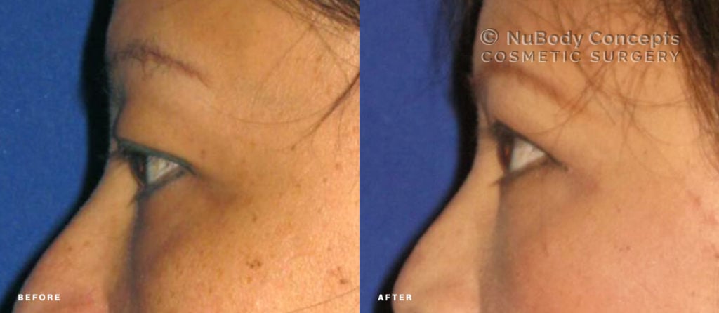 Facelift before and after picture of NuBody Concepts patient