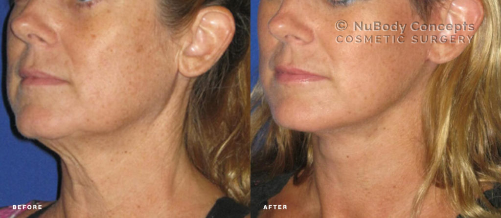 Facelift before and after picture of NuBody Concepts patient