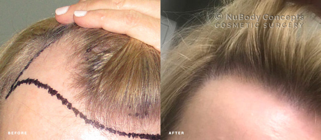 Female NuBody Concepts Hair Restoration Before & After