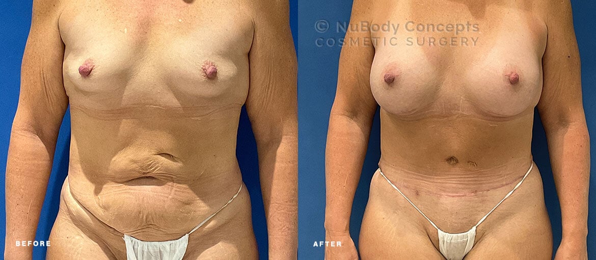 Mommy makeover before and after picture of NuBody Concepts Nashville patient by Dr Rosdeutscher - front