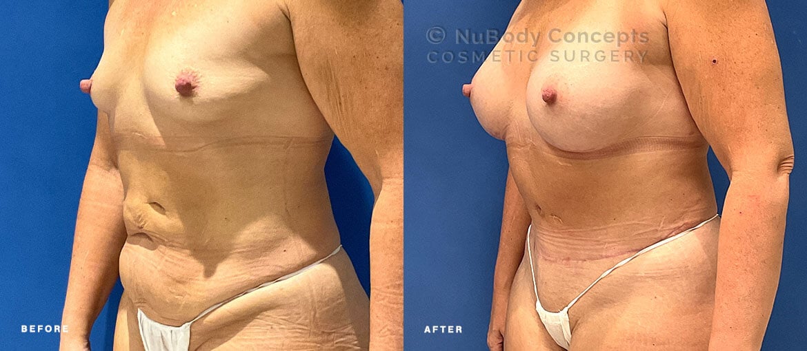 Mommy makeover before and after picture of NuBody Concepts Nashville patient by Dr Rosdeutscher - oblique