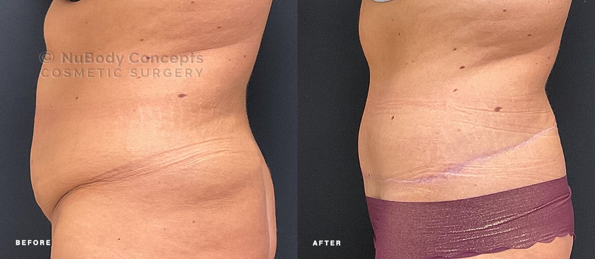 NuBody Concepts Memphis tummy tuck patient before and 6 months after procedure