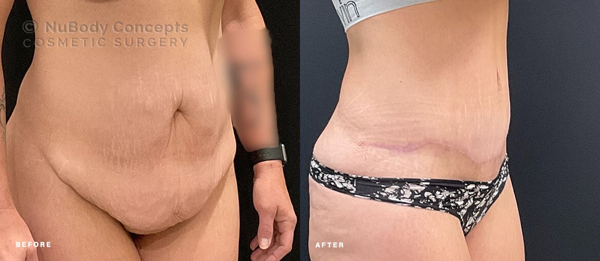 NuBody Concepts Memphis tummy tuck patient before and 6 months after procedure