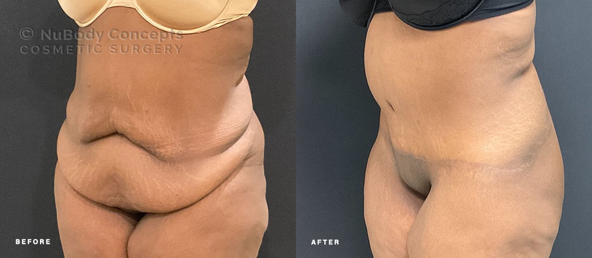 NuBody Concepts Memphis tummy tuck patient before and 12 months after procedure