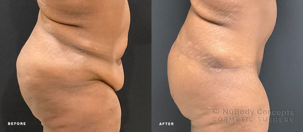 NuBody Concepts Memphis tummy tuck patient before and 12 months after procedure