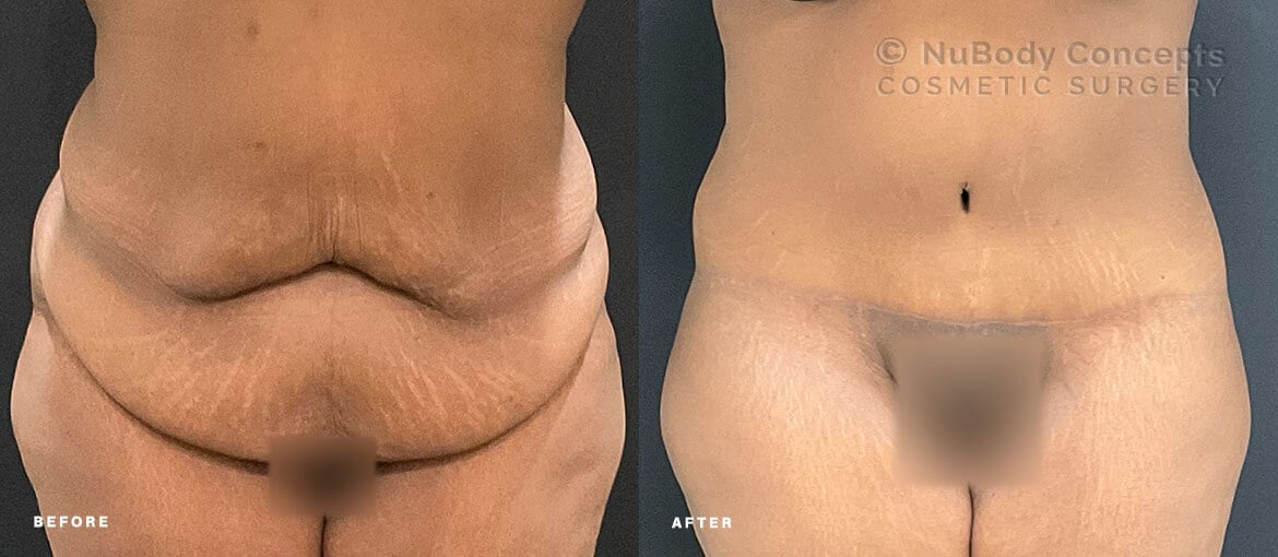 NuBody Concepts Memphis tummy tuck patient before and 1 month after procedure (front view)