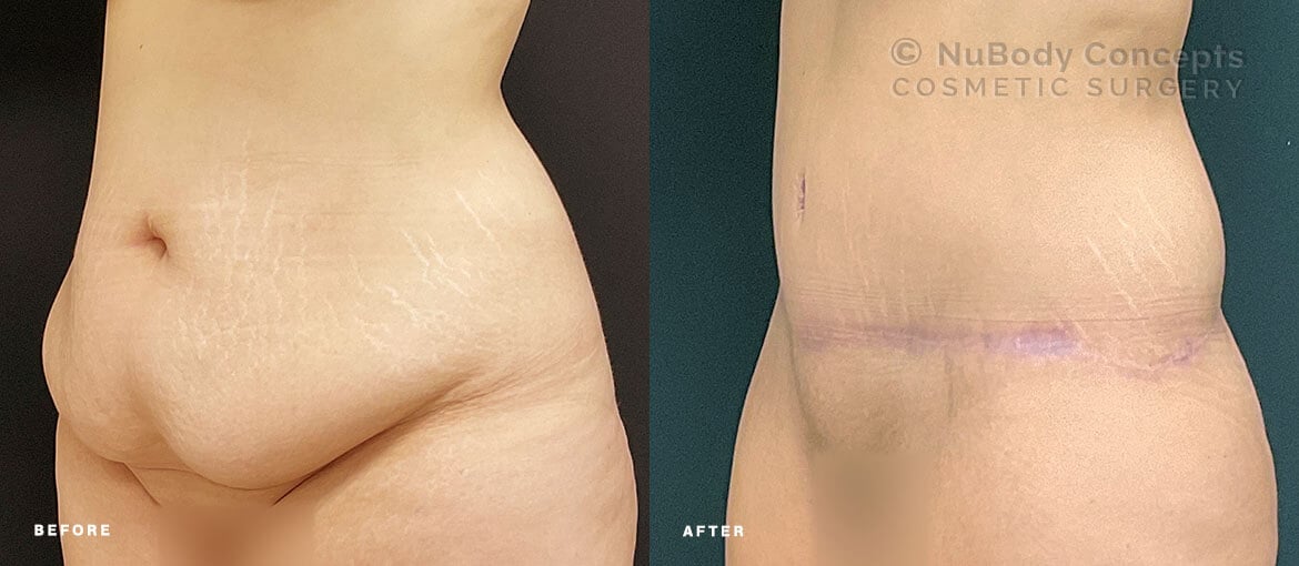 NuBody Concepts Nashville tummy tuck patient before and 1 month after procedure (oblique view)